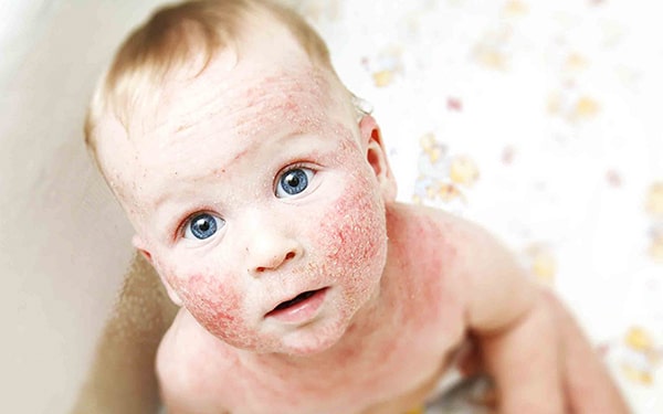 Kuruyemiş alerjisi hakkında faydalı bilgiler Ofix Blog'da...